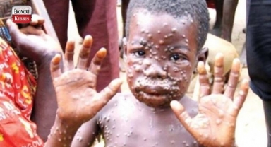 Maymun çiçeği hastalığı (monkeypox) hızla yayılıyor! İşte detaylar...
