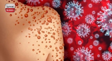 Yakın Doğu Üniversitesi araştırmacıları, maymun çiçeği hastalığını 1 saatte saptayabilen PCR tanı kiti geliştirdi! İşte detaylar...